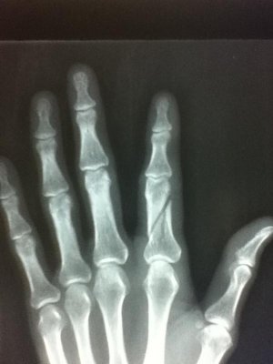 Broken Bones 004.jpg